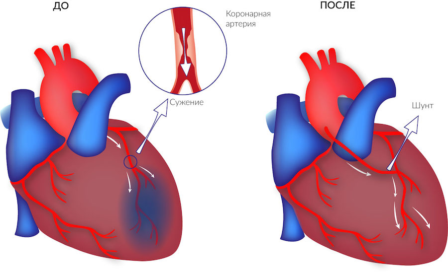 Аортокоронарное шунтирование